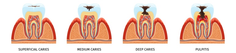 임플란트에도 충치가 생긴다? Yes or No? 관련 이미지 3