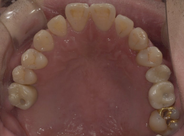 상악동거상술과 뼈이식임플란트 실제 치료사례로 보여드립니다. 관련 이미지 9