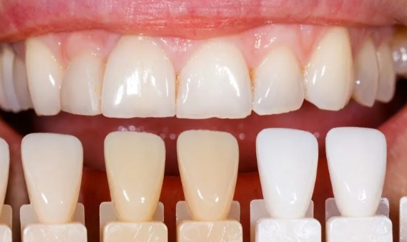 치아미백 지속기간,가격, 부작용, 횟수, 총정리 해드립니다. 관련 이미지 8