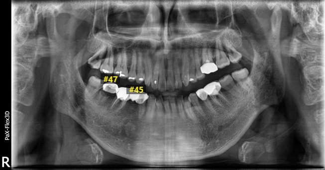 어금니임플란트, 당일식립한 사례부터 비용까지 관련 이미지 6