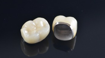 PFM? 지르코니아? 치아색 크라운 전격 해부 관련 이미지 2