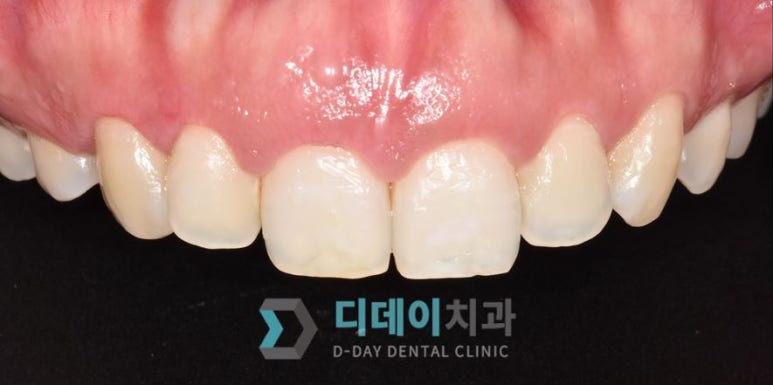 치아성형 종류, 비용, 장단점까지 완벽정리 관련 이미지 12