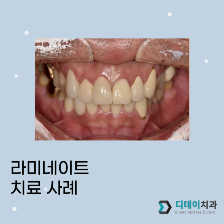압구정라미네이트? "10년 전 보철물이 깨졌어요" 관련 이미지 4