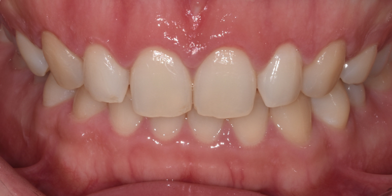 선릉치과? 치료받기 전에 꼭 알아야 할 것 관련 이미지 11