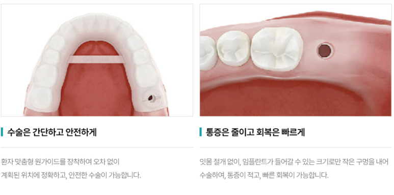 네비게이션 임플란트, 장단점 솔직하게 공개합니다 (feat. 치료비용공개) 관련 이미지 2