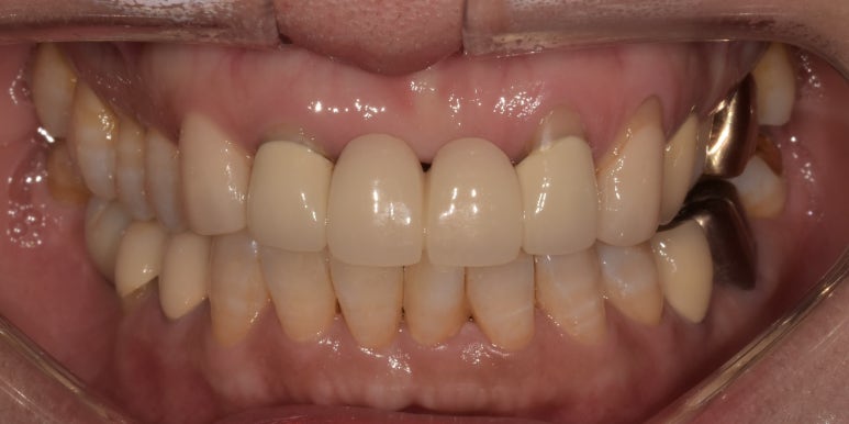 앞니브릿지, 오래된 브릿지교체하신 치료사례와 비용공개합니다. 관련 이미지 7