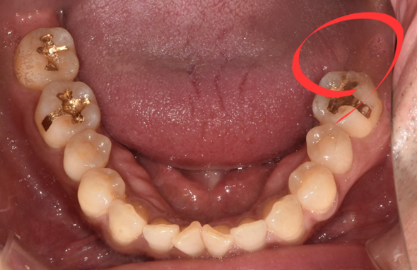 국산임플란트를 선택한 이유, 치료사례 공개합니다 관련 이미지 3