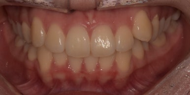 덧니교정만 된다? 라미네이트로도 덧니 치료 가능합니다. 관련 이미지 7