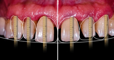 Laminated Veneer Removal: If You Want It Done Safely Without Pain, Check Just One Thing image 5