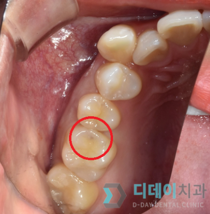 왼쪽어금니통증, 방치하면 안 되는 이유 3가지 관련 이미지 3