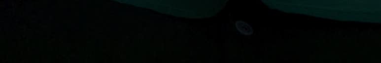 앞니뿌리충치, 치료과정 정리해드립니다. 관련 이미지 14