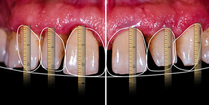 서초동라미네이트, 잘하는 치과특징 3가지 정리했습니다 관련 이미지 7