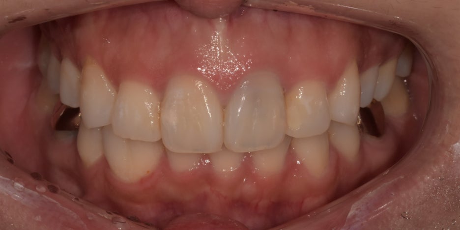 프로필 촬영 전 치아미백 꼭 필요할까요? 관련 이미지 8