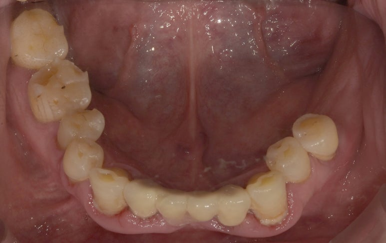 임플란트브릿지? 치아 개수대로 임플란트 심지 않아도 됩니다 관련 이미지 3
