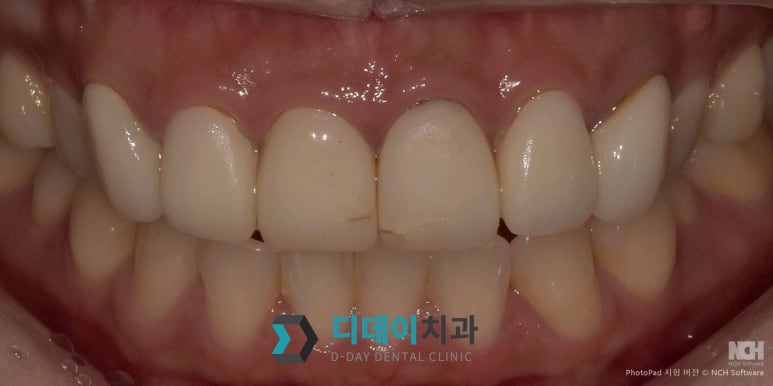 어금니크라운가격 궁금하세요 이것만큼은 알고 가세요 관련 이미지 7