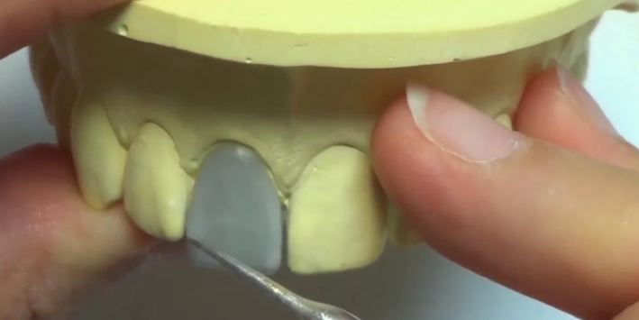 서초동라미네이트, 잘하는 치과특징 3가지 정리했습니다 관련 이미지 8