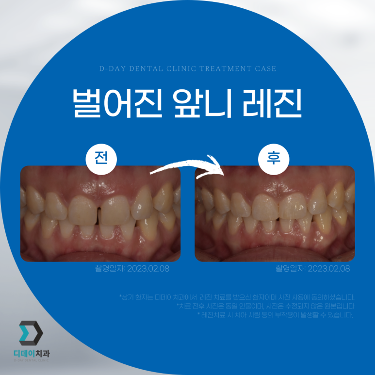 앞니레진수명, 얼마나 오래 사용할 수 있을까요? 관련 이미지 3