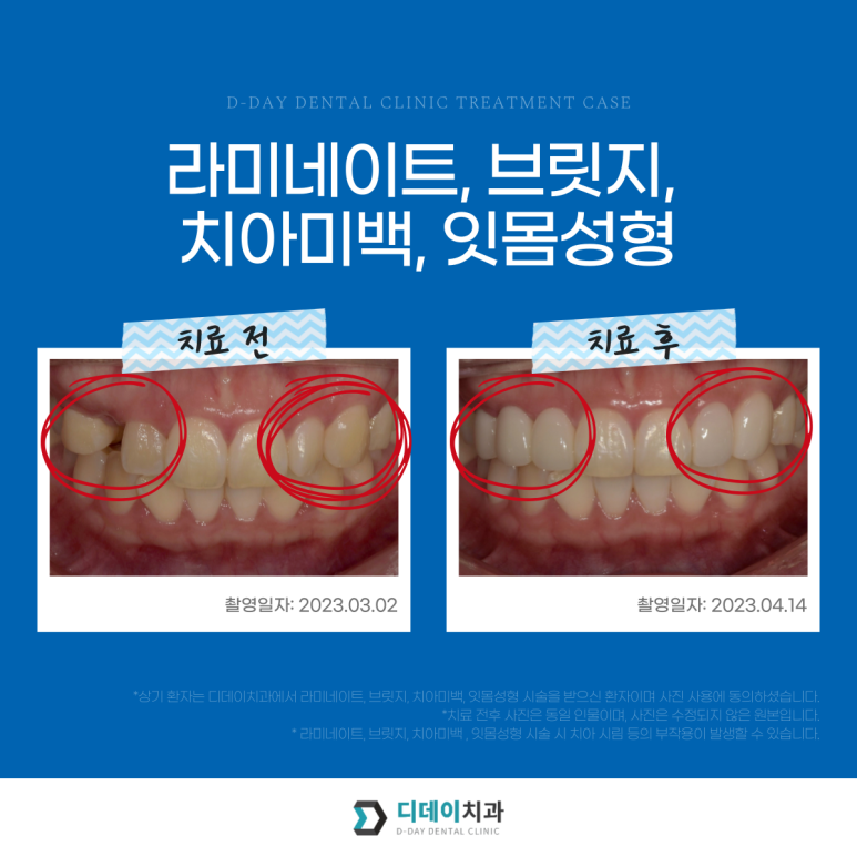 앞니브릿지와 라미네이트를 같이 해도 자연스러울까? 사례로 보여드립니다. 관련 이미지 2