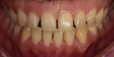 치아성형, 앞니 모양 획기적으로 바꾸는 방법이 있다? 관련 이미지 6