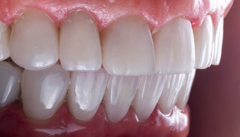 앞니임플란트임시치아 주의사항부터 기간, 통증까지 [FAQ] 관련 이미지 3