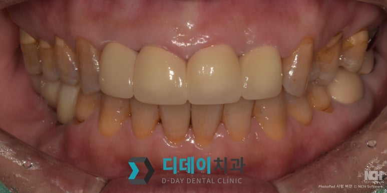 지르코니아크라운가격 차이? 의사가 직접 설명하는 3가지 기준 관련 이미지 5