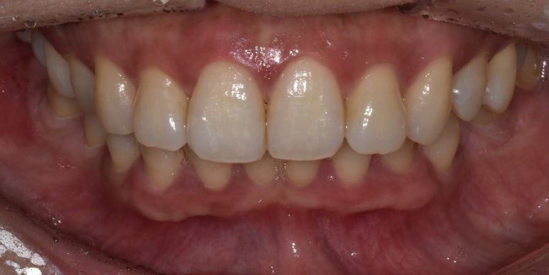 잇몸이까매요... 잇몸착색 치료방법, 사례, 비용 대공개 관련 이미지 5