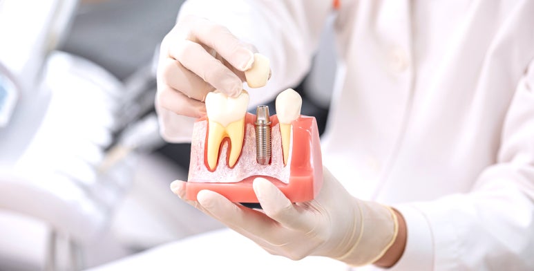 임플란트가격싼곳? 최종 치료비용은 더 비싼 관련 이미지 1