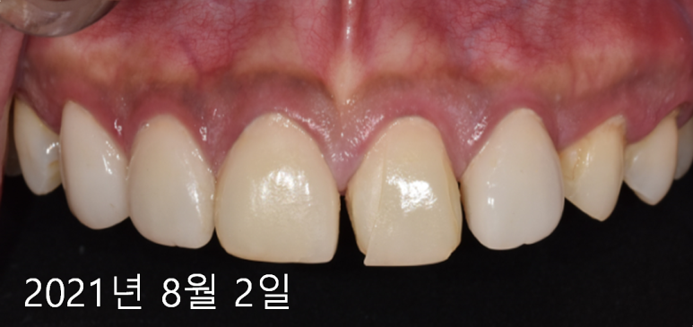 라미네이트 주의사항? 잘못 시술되면 이런 부작용 옵니다... 관련 이미지 4