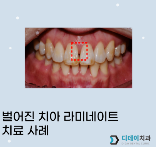 서울라미네이트? 전문의가 설명드립니다. 관련 이미지 1