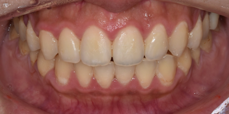 교정후라미네이트? 실제 치료 후기 궁금하신 분만 관련 이미지 4