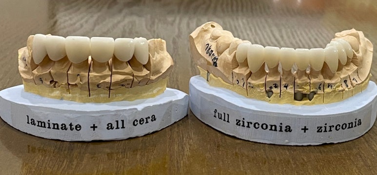 올세라믹vs지르코니아 크라운 비교분석과 비용까지 관련 이미지 2