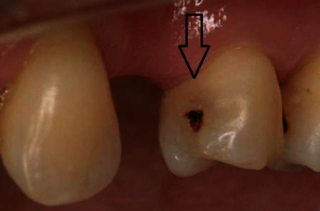 어금니쪽 충치 통증, 관련 이미지 2