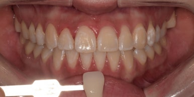 치아다듬기, 만만하게 생각할 치료는 절대 아닙니다. 관련 이미지 7