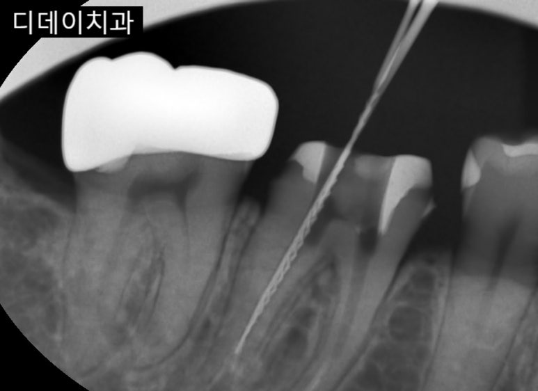 충치신경치료 그렇게 아픈가요? 신경치료통증 오해와 진실 관련 이미지 1
