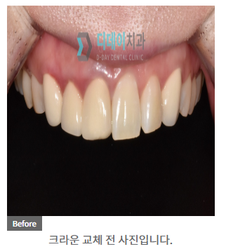 실활치미백, 만족도 높은 환자들의 공통점 3가지 관련 이미지 5