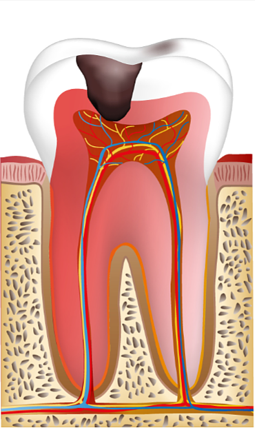 신경치료고통? 통증을 줄이는 방법은 바로 OO입니다. 관련 이미지 7