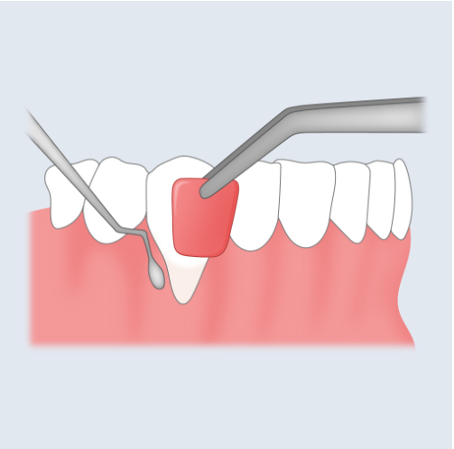 연예인 잇몸성형 방법과 비용은? 관련 이미지 2