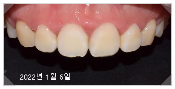 잇몸수술비용? 이 글로 종결합니다. 관련 이미지 10