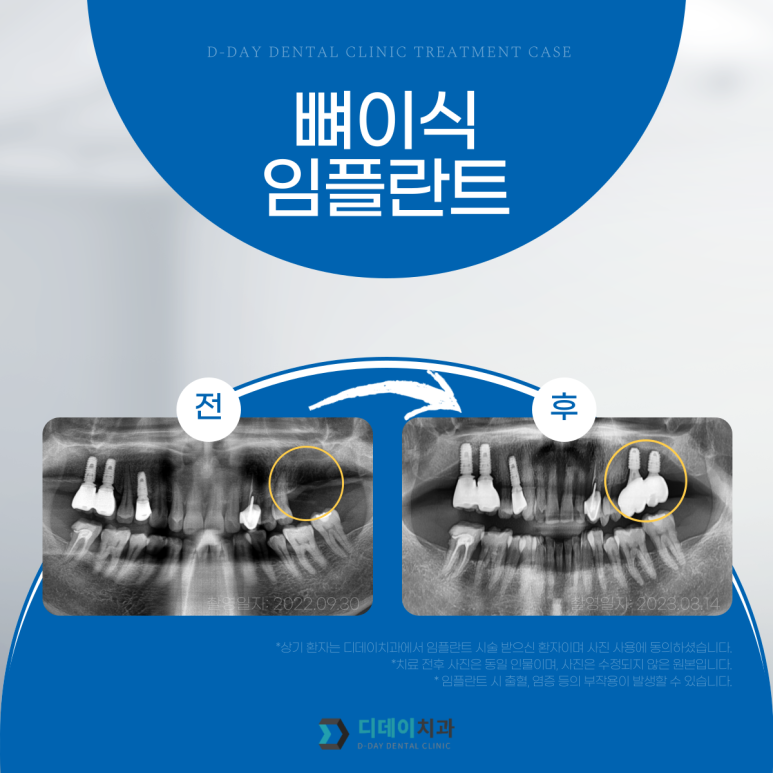 임플란트싼곳? 가격만 보다가 후회할 수도 있습니다 관련 이미지 2