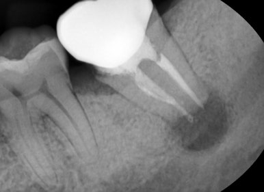 잇몸에혹? 물집? 원인과 치료방법 자세히 설명해 드립니다. 관련 이미지 3