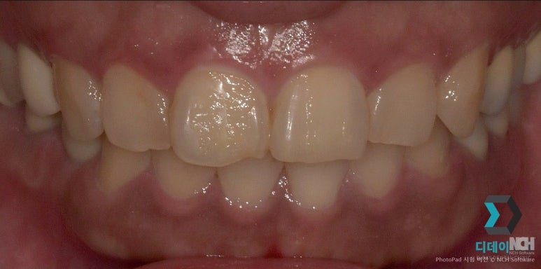 언주역라미네이트 잘하는 치과 특징 3가지 원장 작성 관련 이미지 4