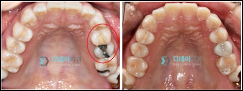 충치치료아픈가요? 치과의사가 알려드릴게요. 관련 이미지 4