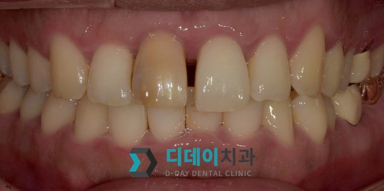 강남 올세라믹 지르코니아 어떤 보철물이 좋을까요? 관련 이미지 3