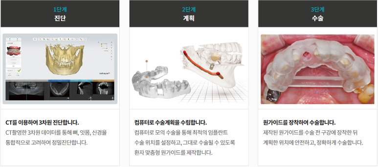 3D임플란트, 네비게이션 비용/통증/과정 총정리 관련 이미지 1