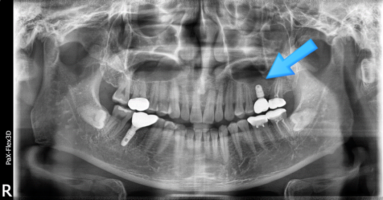 임플란트상악동거상술, 통증은 OO 때문이다? 관련 이미지 5
