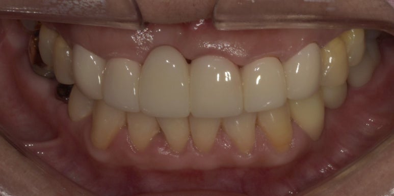 앞니브릿지, 임플란트와의 차이점과 가격까지 비교분석 관련 이미지 7