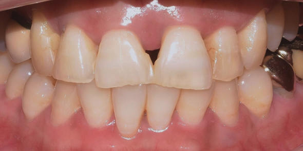 앞니성형? 치아만 바뀌어도 달라지는 이미지 (대공개) 관련 이미지 5