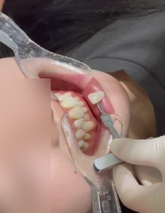 선릉역치아미백 리뷰 보기 전에 관련 이미지 11