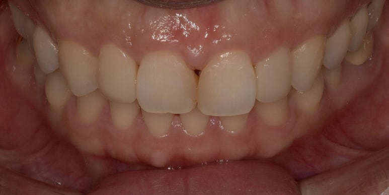 앞니레진수명, 얼마나 오래 사용할 수 있을까요? 관련 이미지 7