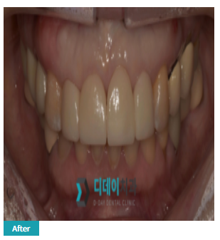 재교정 vs 라미네이트 고민되신다면, 이 글로 종결! 관련 이미지 4
